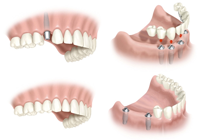 Implantes