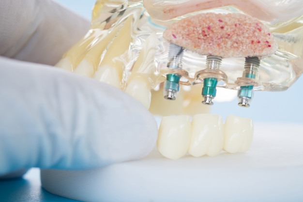 MITOS SOBRE LOS IMPLANTES DENTALES