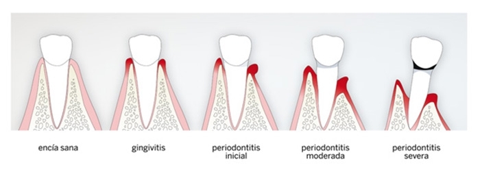 ¿QUÉ ES LA PERIODONTITIS Y POR QUÉ APARECE?