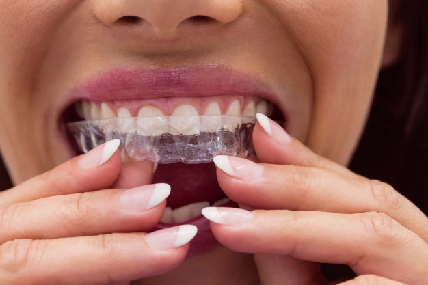 NOTICIA: Qué es invisalign y por qué es el tratamiento dental más solicitado.